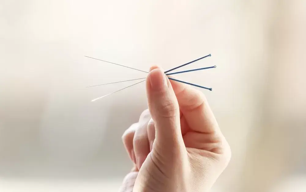 What is Acupuncture Treatment