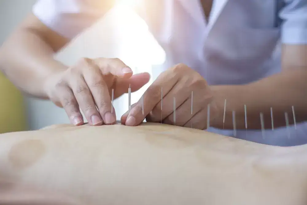 Acupuncture-in-Mississauga