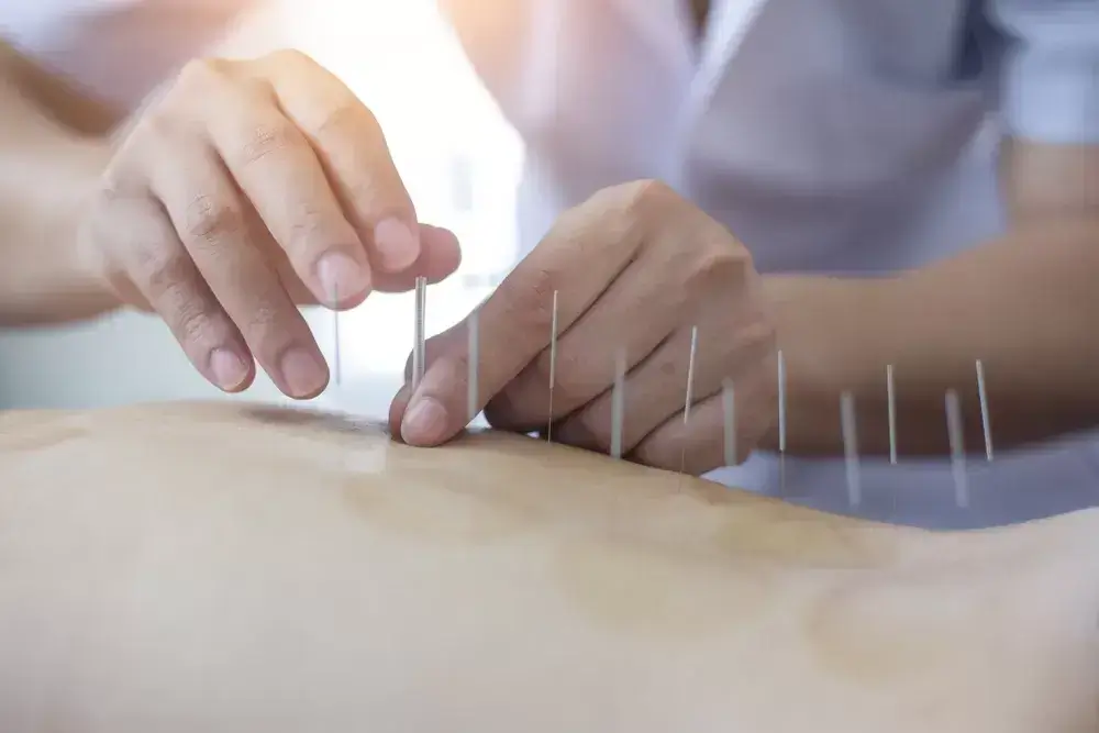 Acupuncture-treatment-in-Mississauga