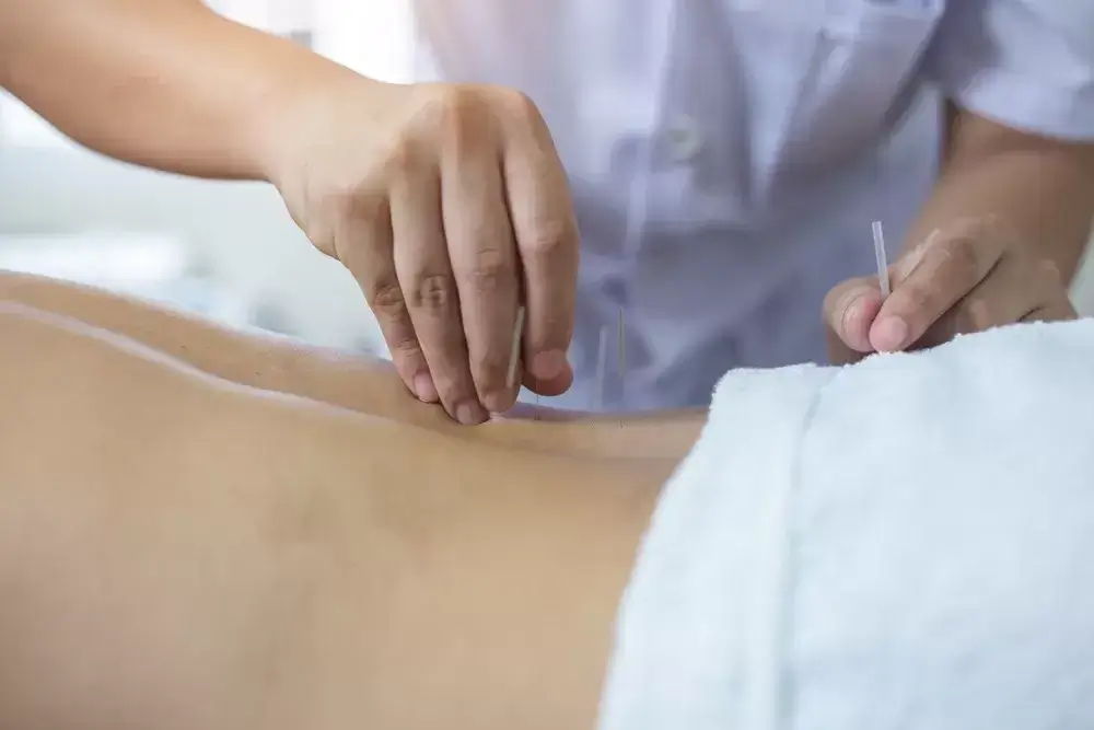 Best-Acupuncture-Treatment-near-Mississauga