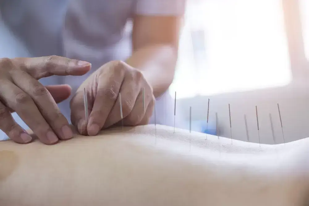 Mississauga Acupuncture Treatment