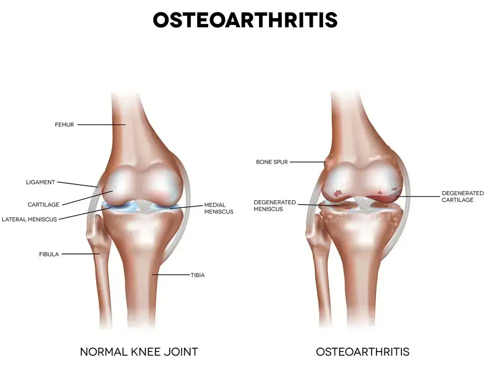 Osteoarthritis-Symptom-near-Mississauga-Ontario