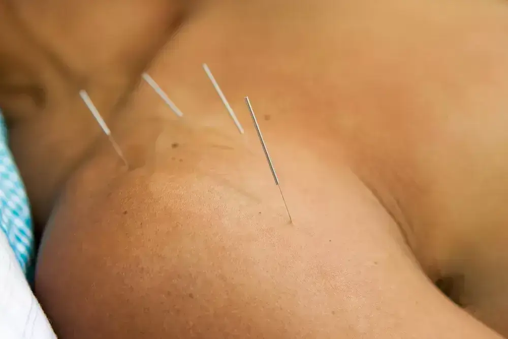 Shoulder-and-Joint-Acupuncture-Mississauga-Ontario