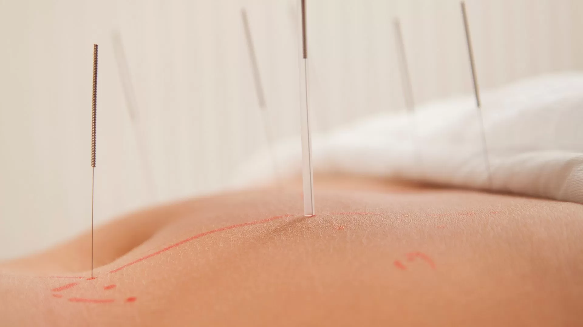 How long will my course of acupuncture treatment last